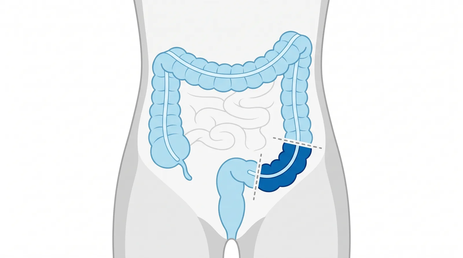 Dibujo del colon y el recto con la parte que se quita en la cirugía marcada en azul