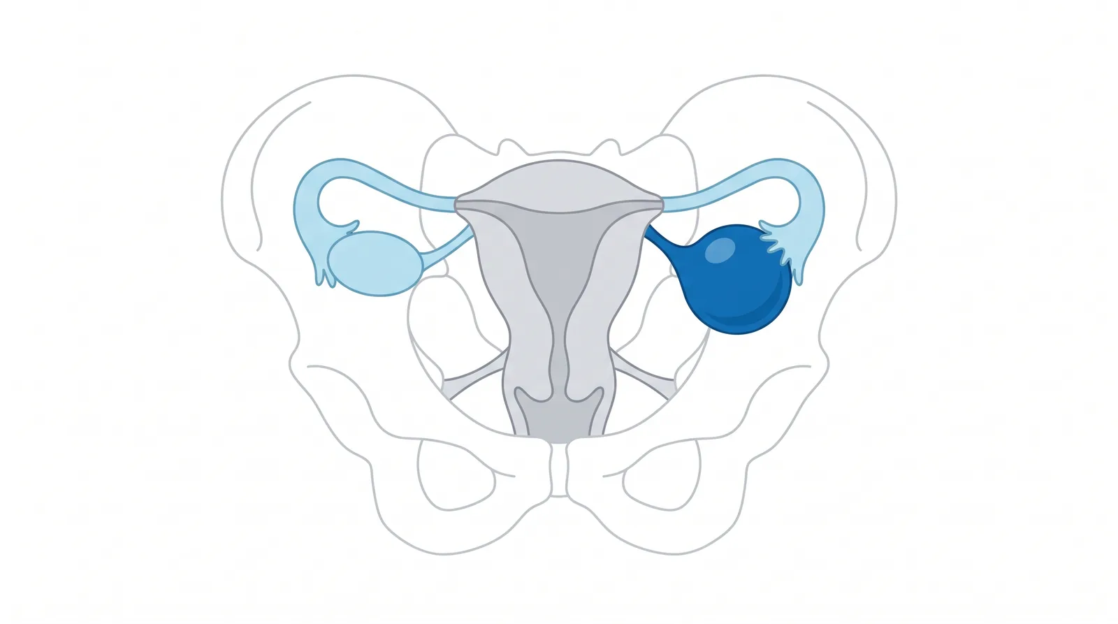 Dibujo de la pelvis femenina con el útero, las trompas y un ovario agrandado por una masa