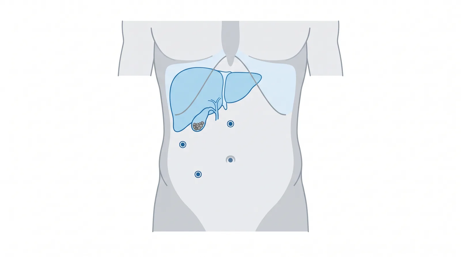 Dibujo del hígado y la vesícula con piedras, con los puntos de las incisiones de la cirugía de vesícula por laparoscopia